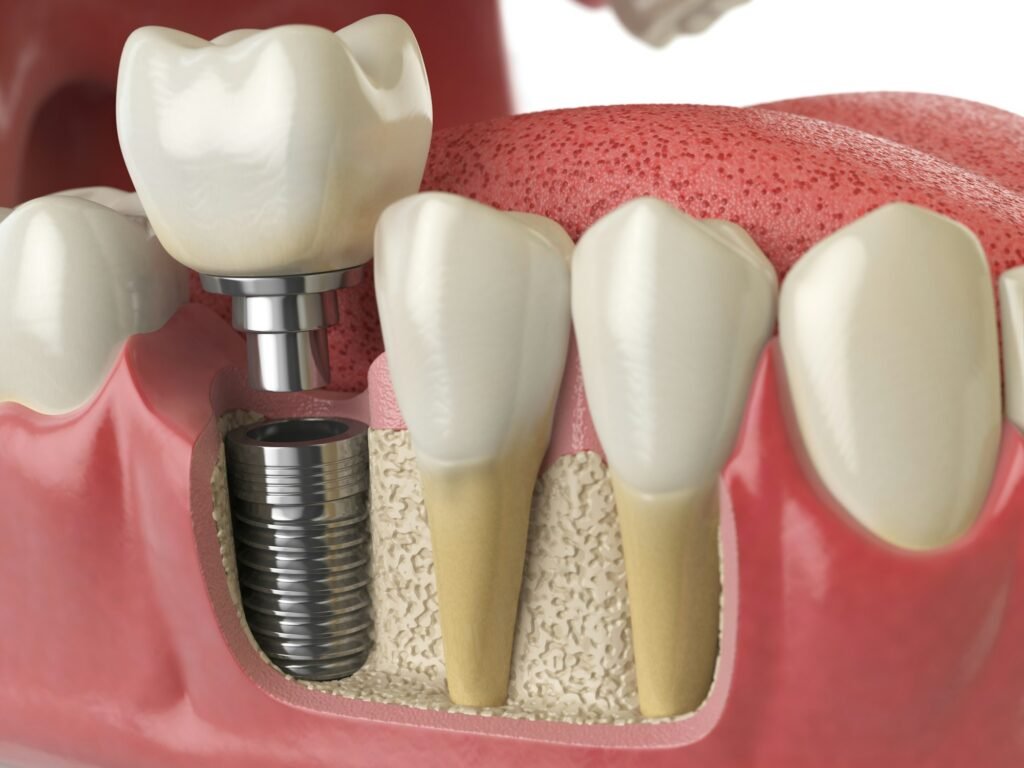 anatomy-of-healthy-teeth-and-tooth-dental-implant-in-human-dentu