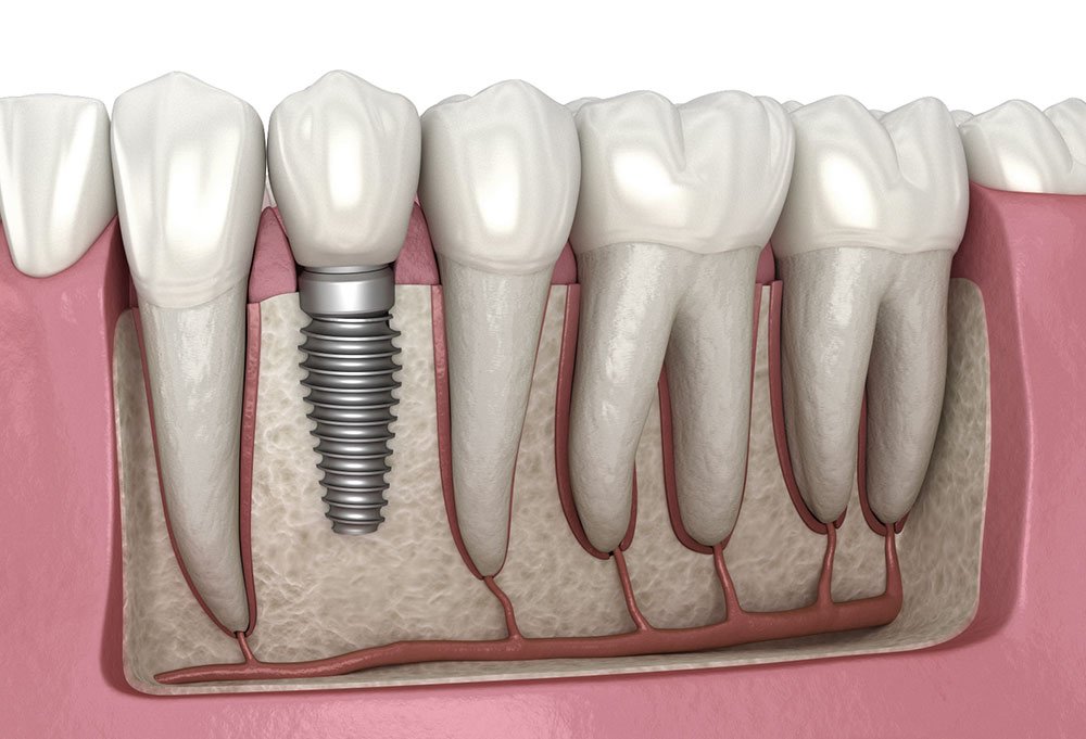 dental implant illustration oldham