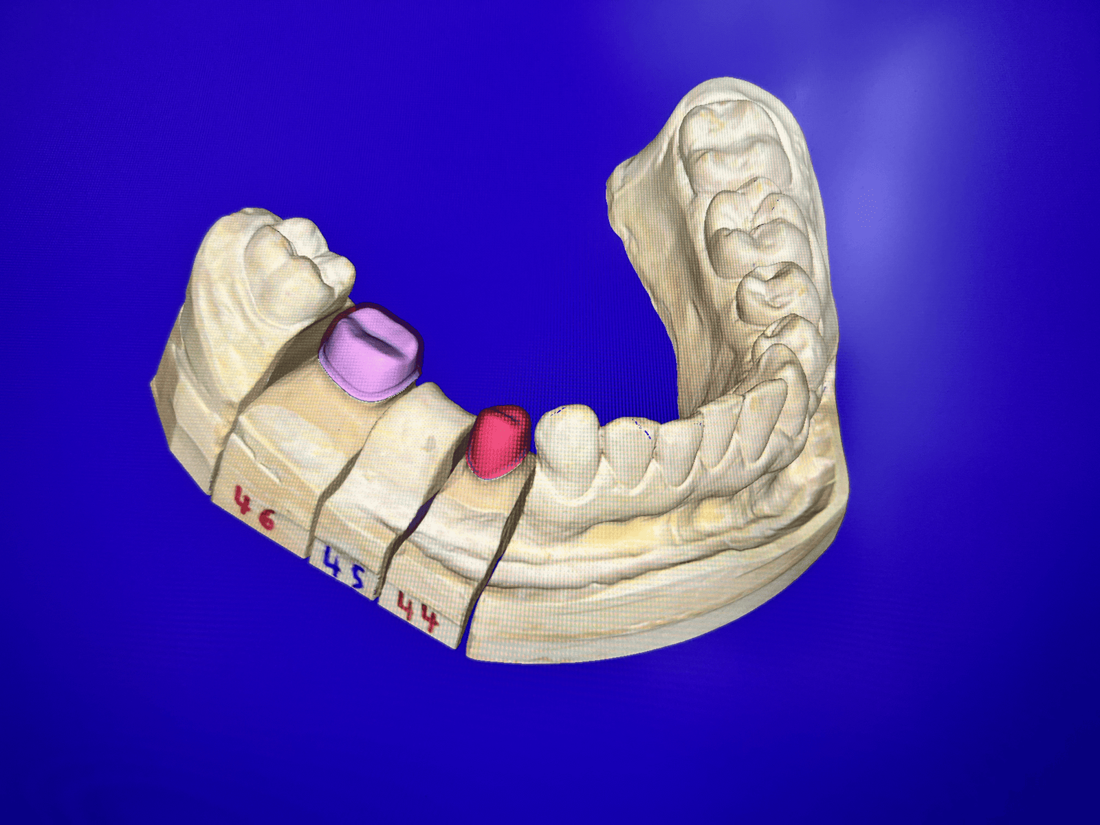 Denture repair Oldham