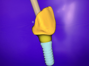 Denture repair Oldham