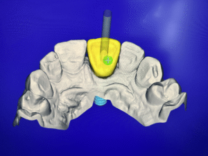 Denture repair Oldham