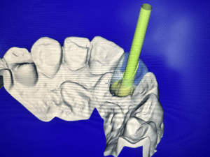 Denture repair Oldham